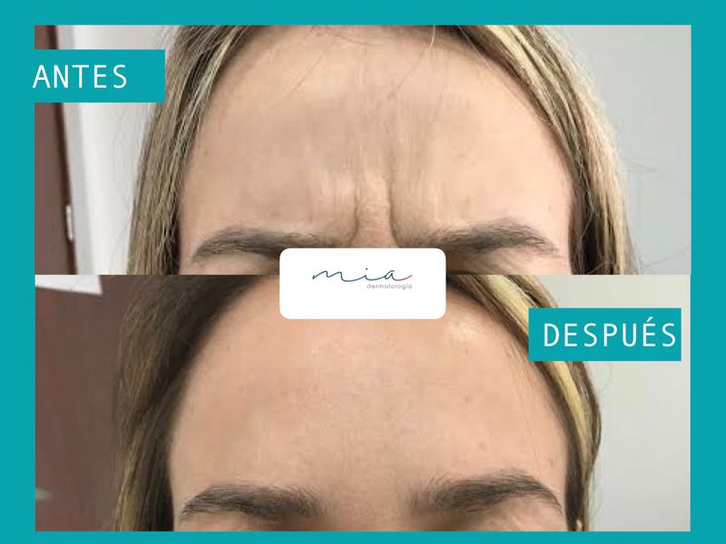 Botox Medellín María Isabel Arredondo