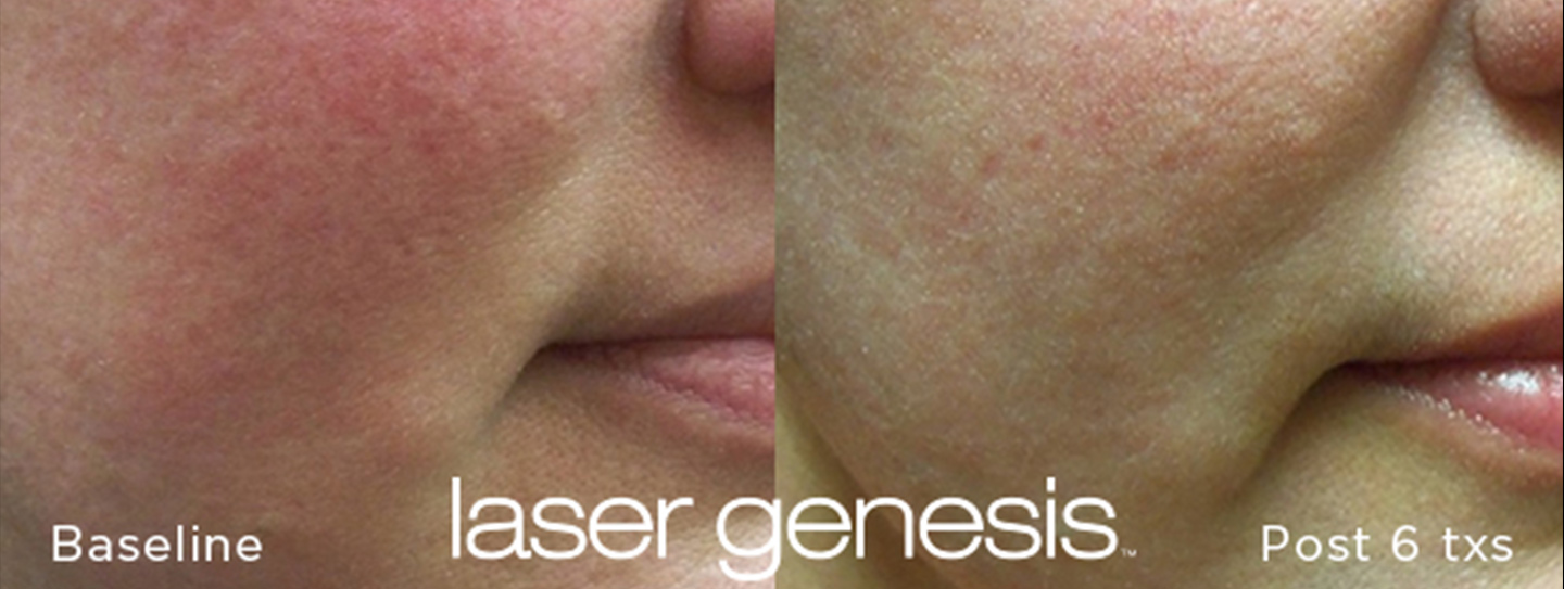Laser Genesis® Miami Innovative Aesthetics