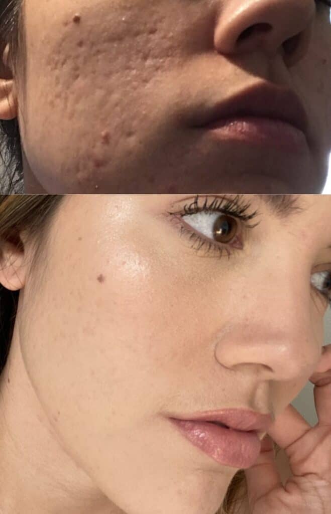 The Most Affordable Way To Get Rid of Acne Scars Hello Mia Wilson
