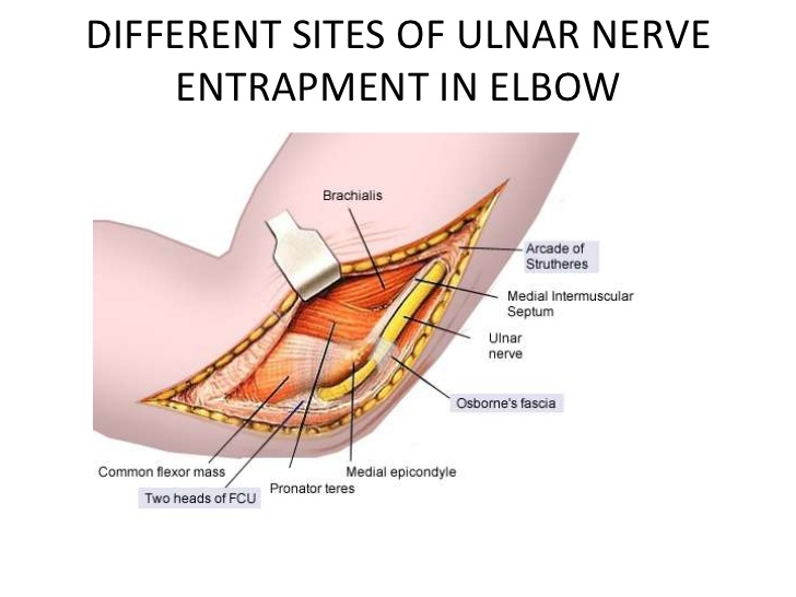 Ulnar nerve surgery doctorvisit