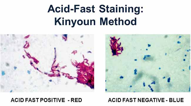 Acid Fast Stain (KinyounCold Method) Principle, Procedure and Result