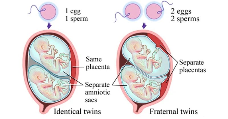 Twins Types, Causes and Significance Microbe Notes
