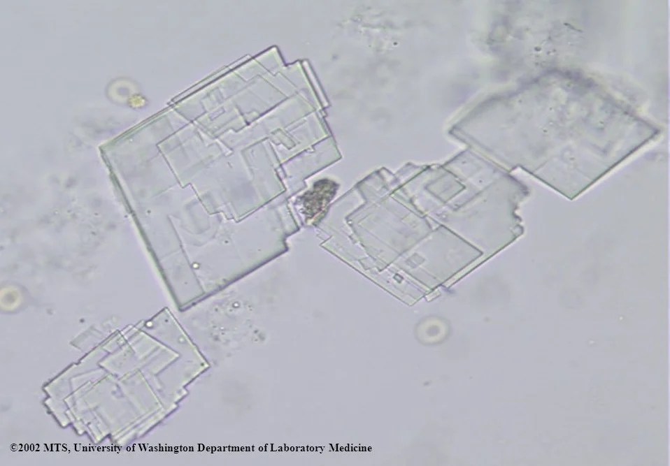 What are the types of Crystals found in Urine?