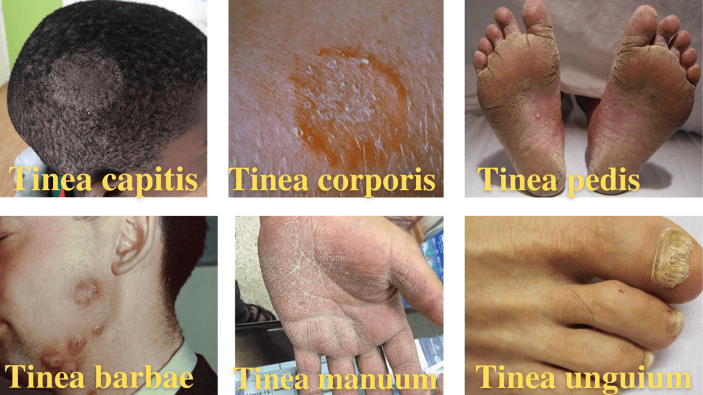 Dermatophytes Tinea and Lab Diagnosis • Microbe Online