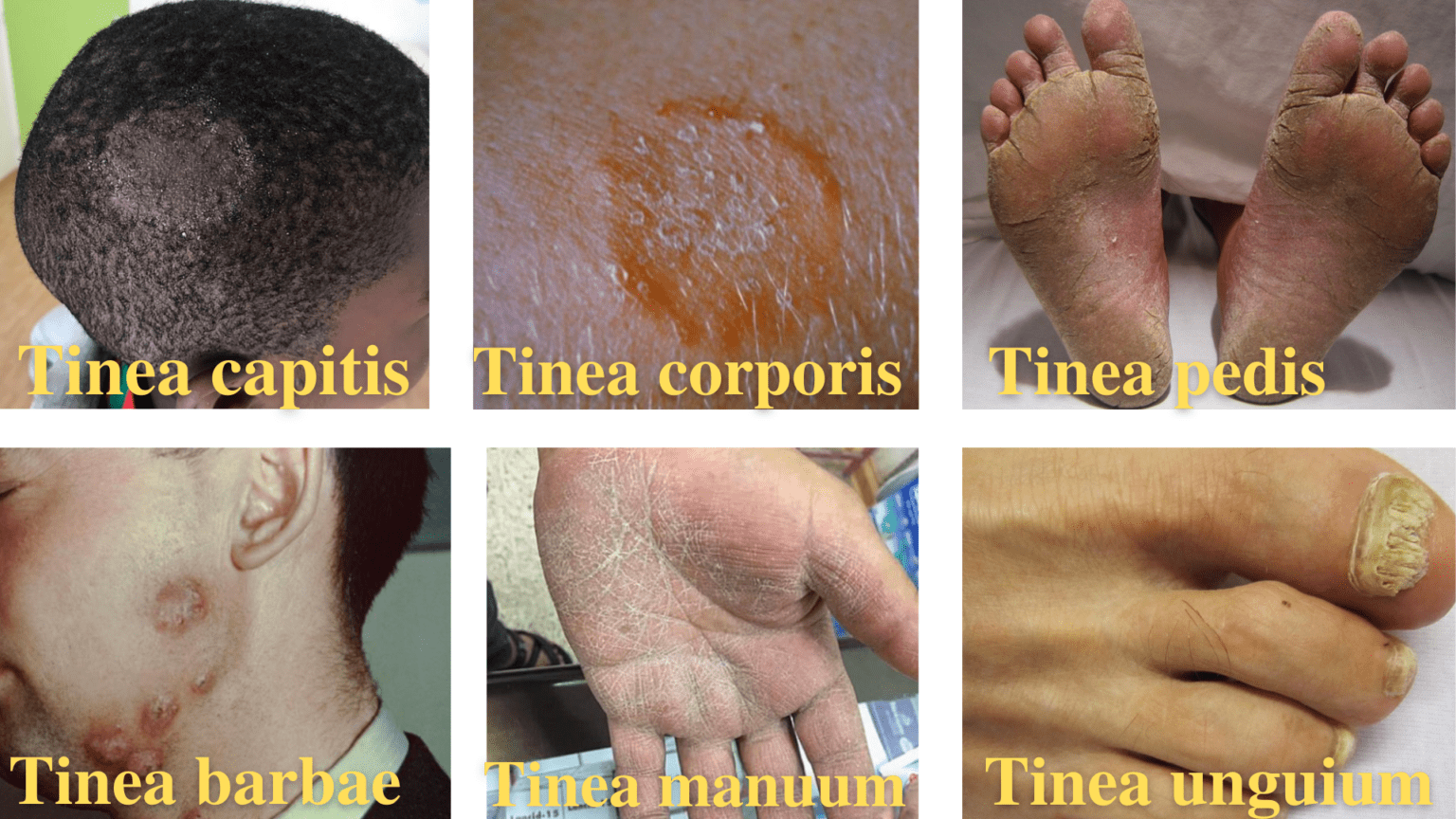 Dermatophytes Tinea and Lab Diagnosis • Microbe Online