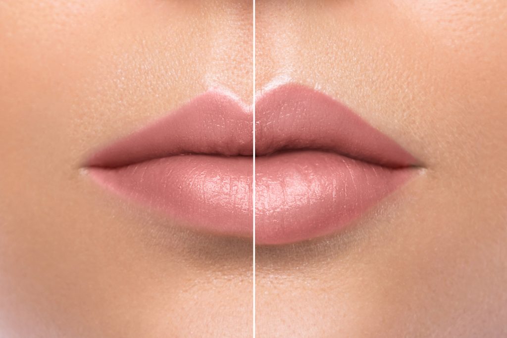 Hyaluron Infusion Achieve Fuller Lips with the Simplest, Most Natural