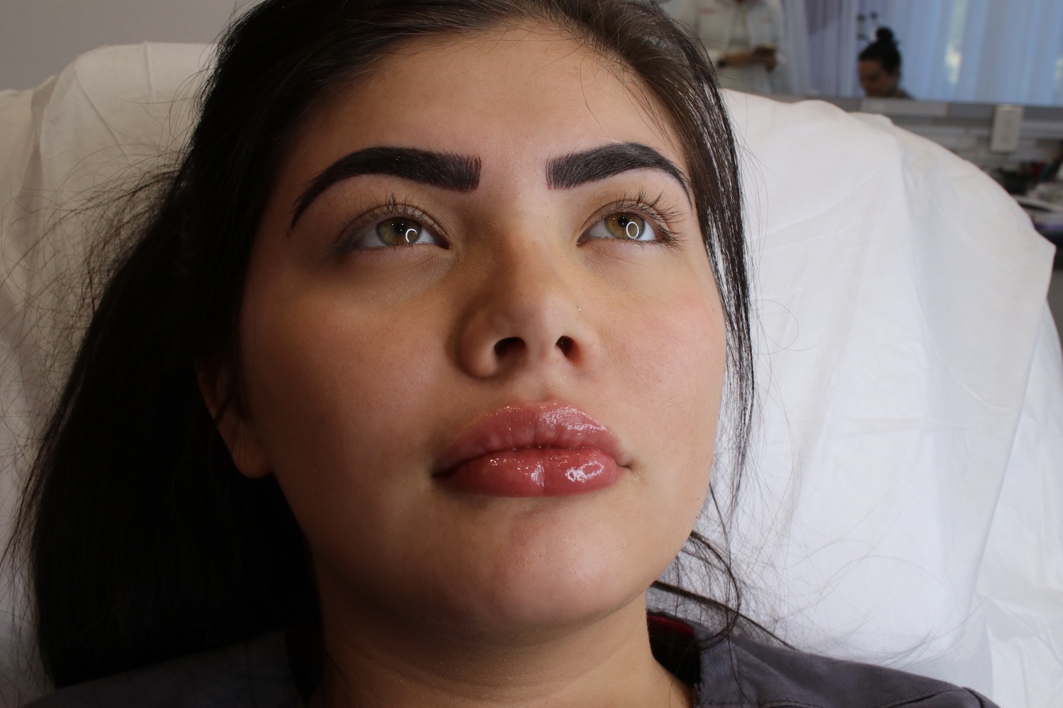 Buyer Beware Risks of Buying Hyaluronic Acid Fillers Online for