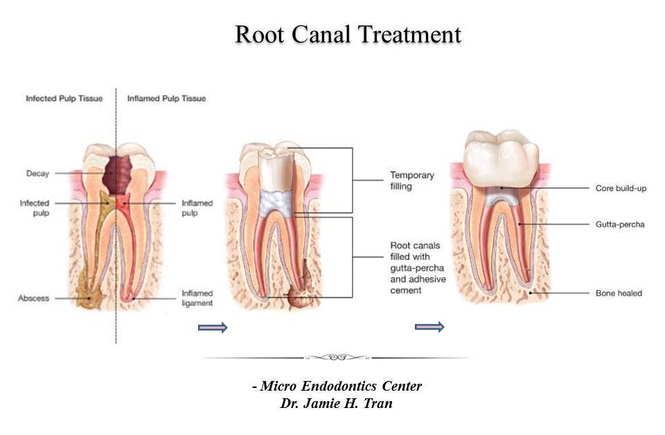 Root Canal Treatment Micro Endodontics Center