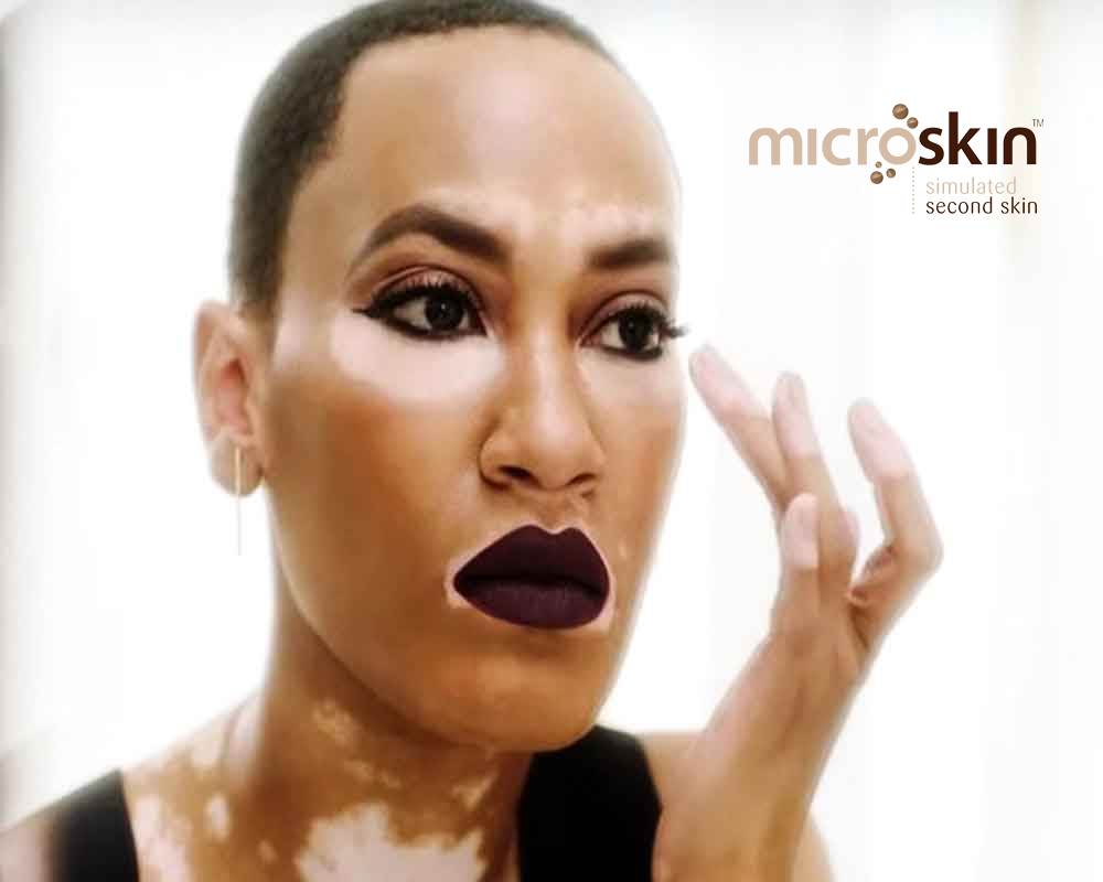 Light Therapy For Vitiligo