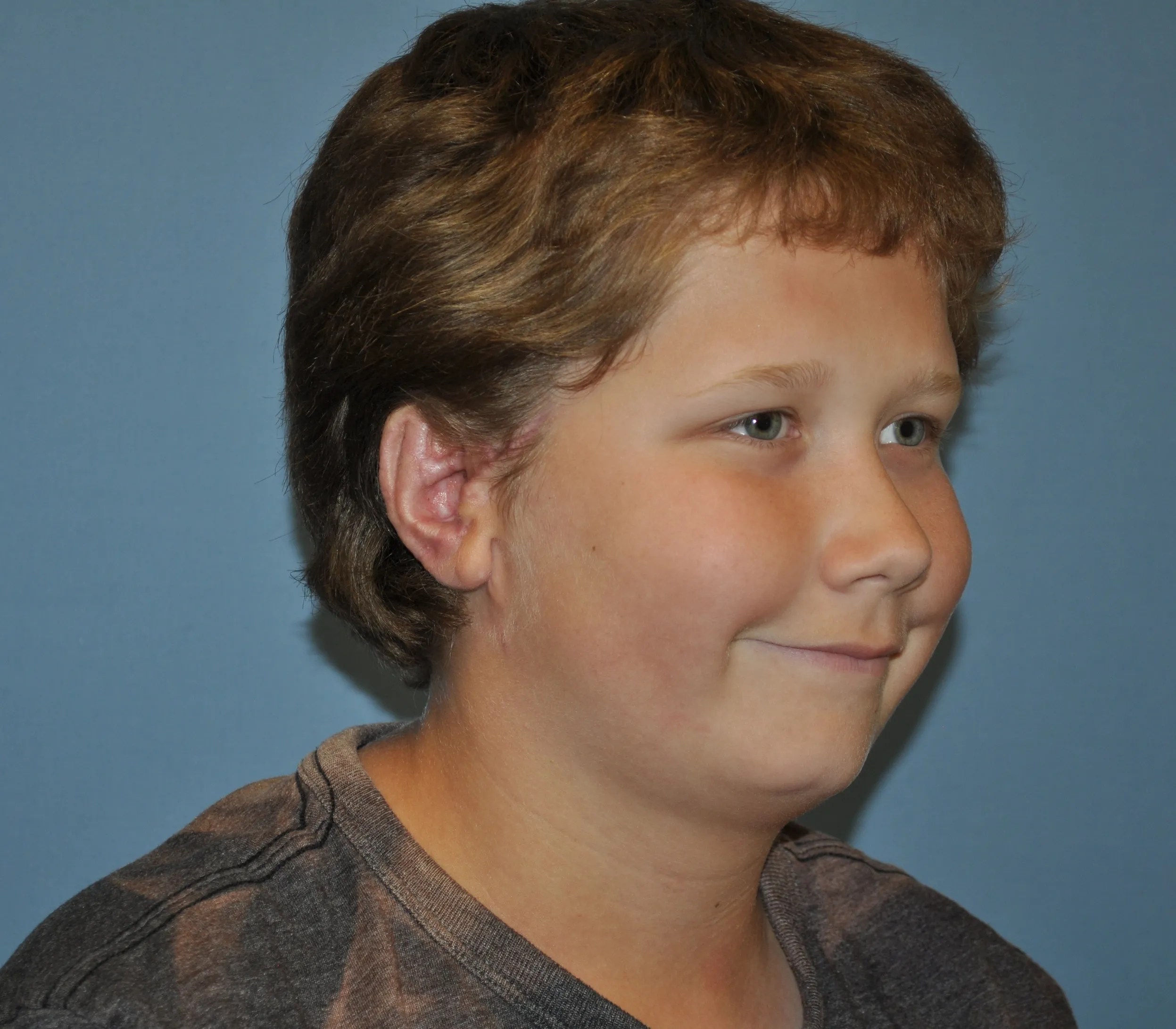 PtD after right facing angled The Microtia and Atresia Clinic at