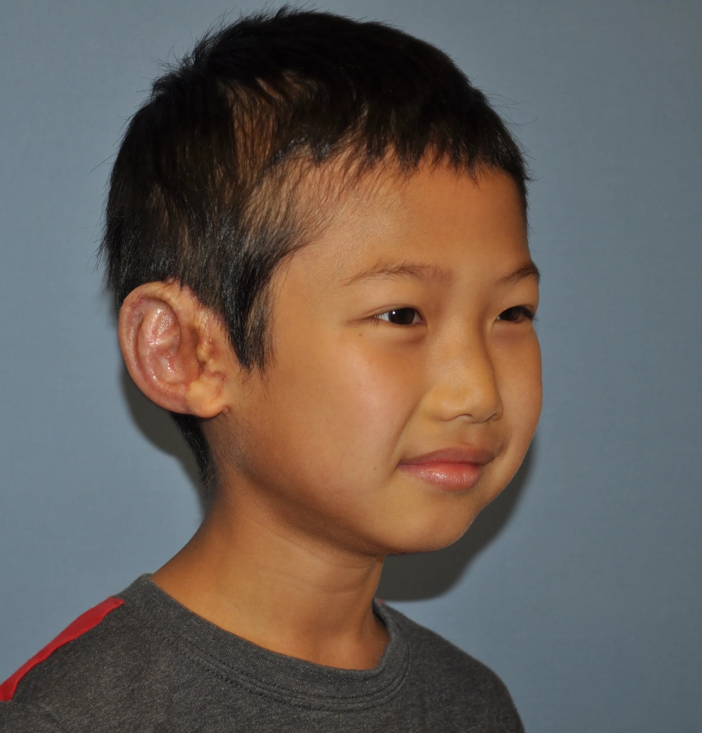 PtE after right facing angled The Microtia and Atresia Clinic at