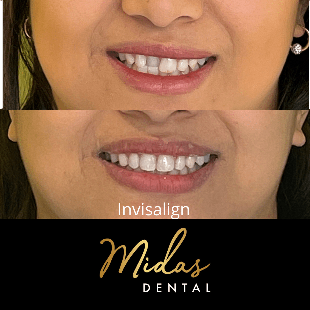 Invisalign Sydney Get Invisible Braces Midas Dental