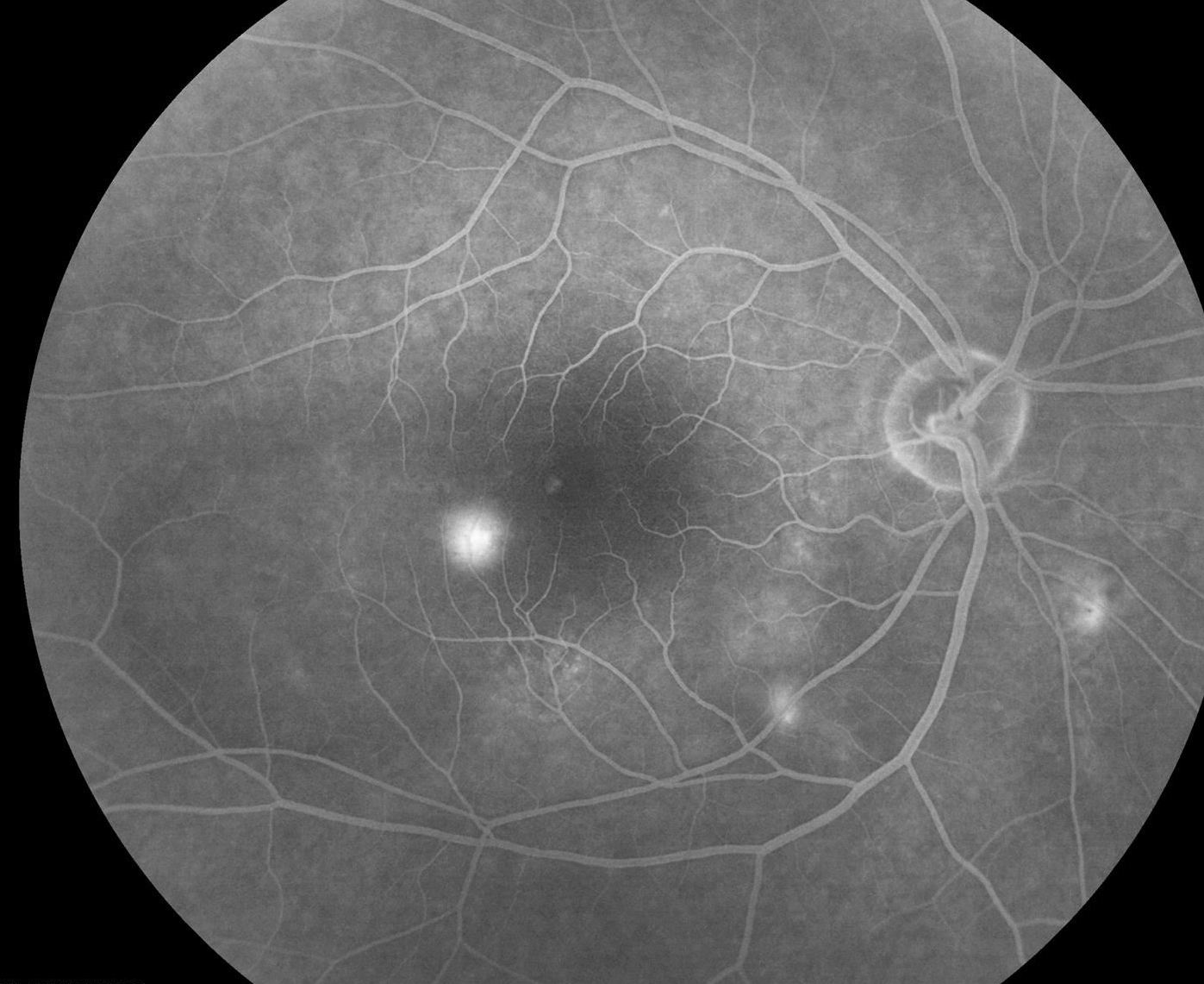 Central Serous Chorioretinopathy Treatment Mid Atlantic Retina
