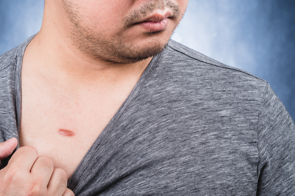 Will Keloid Removal Cost Me Money Out of Pocket? MidAtlantic Skin