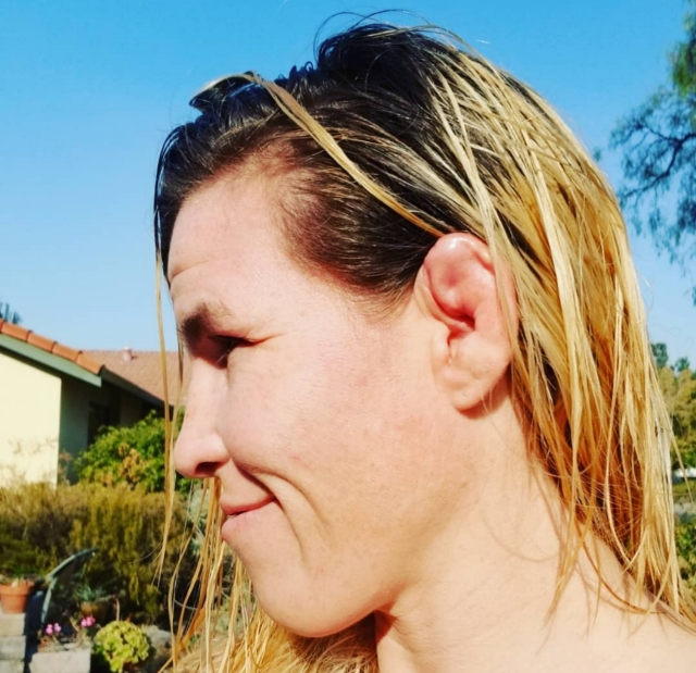 Cauliflower Ear Girl