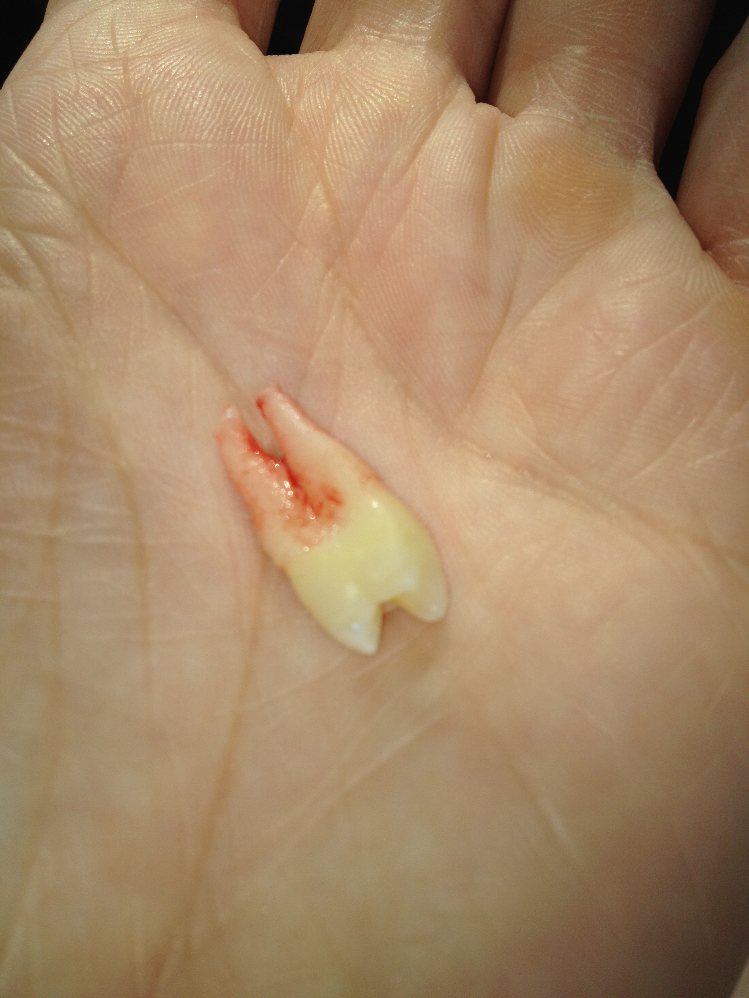 Pulling Teeth | middlegradebookreaders