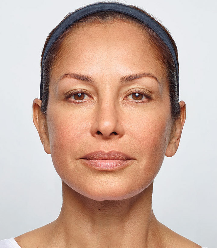 Dysport Mid Florida Dermatology & Plastic Surgery