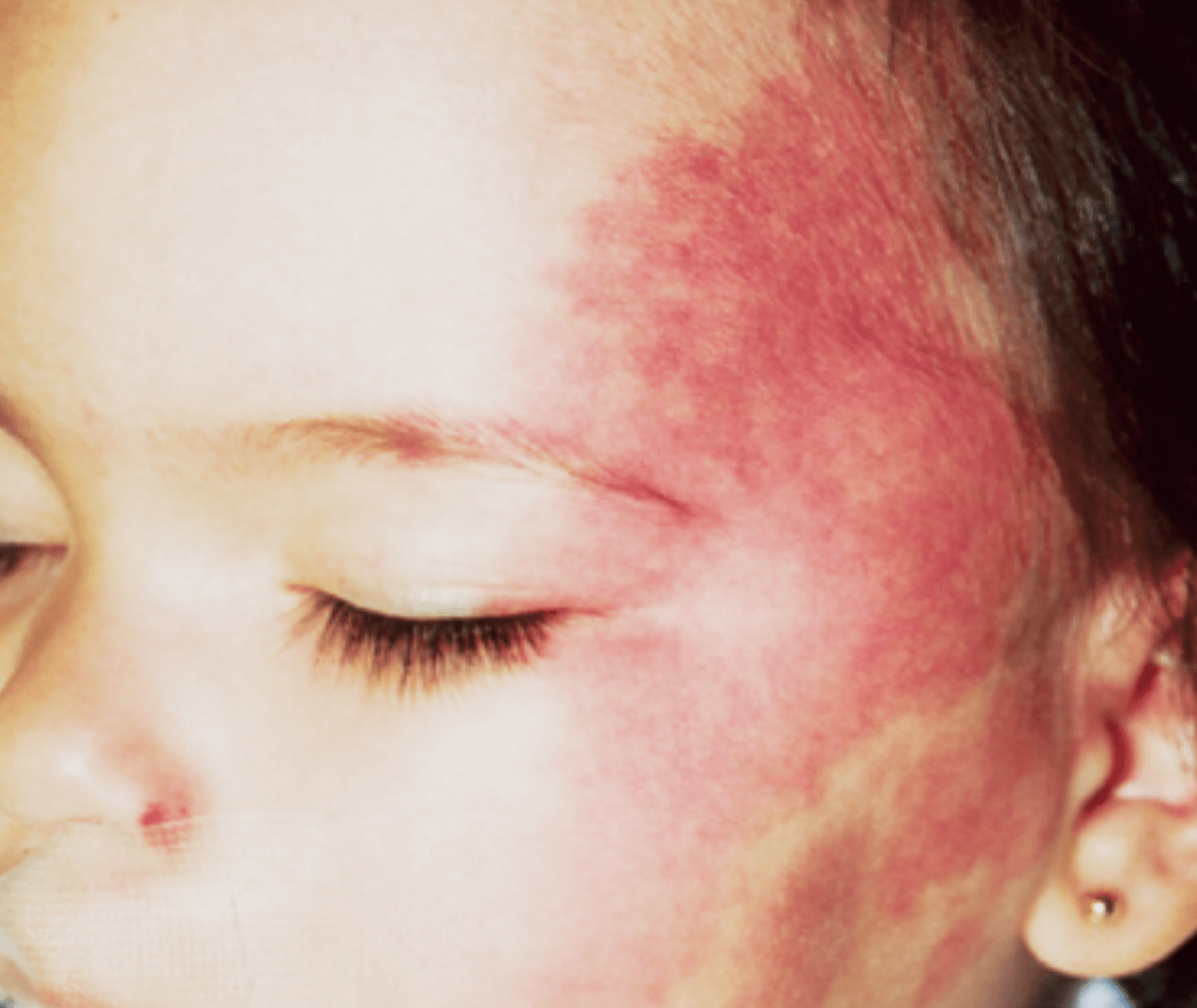 Pulsed Dye Laser Mid Florida Dermatology & Plastic Surgery