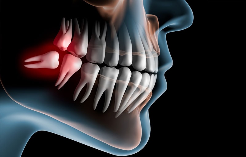 Extractions/Wisdom Teeth MidState Oral Surgery and Implant Center