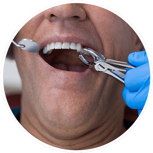 Tooth Extractions in El Cajon CA Dentist Tooth Removal