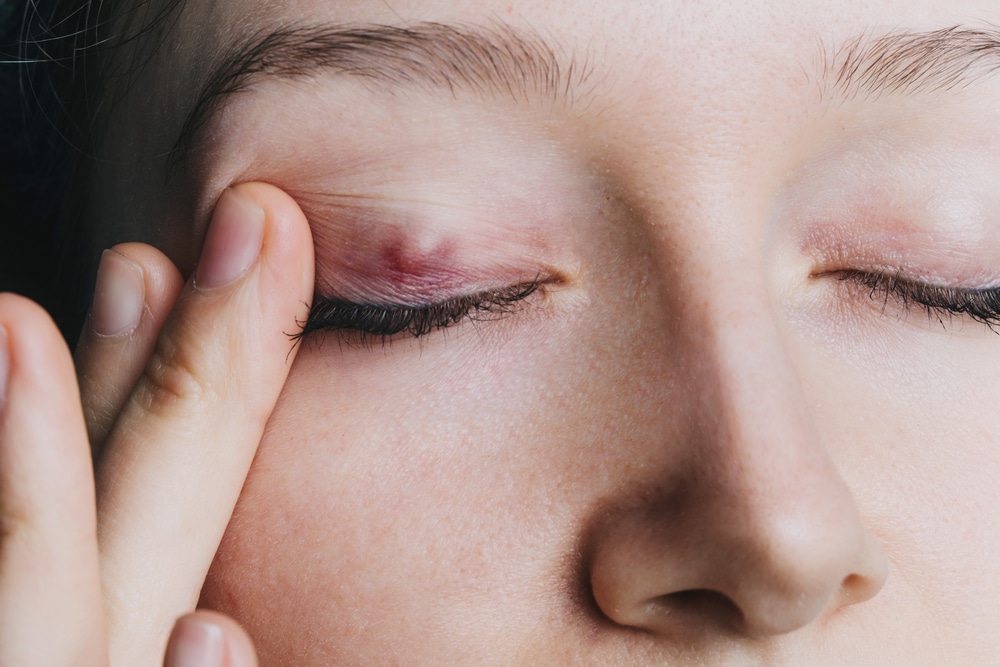 Chalazion Cincinnati Eye Infections Florence, KY MidWest Eye