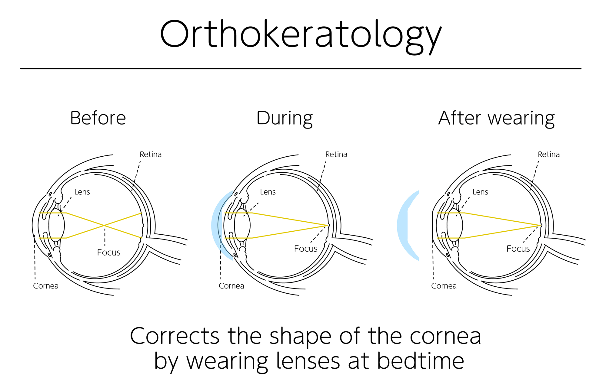 Orthokeratology (OrthoK) Midwest Myopia