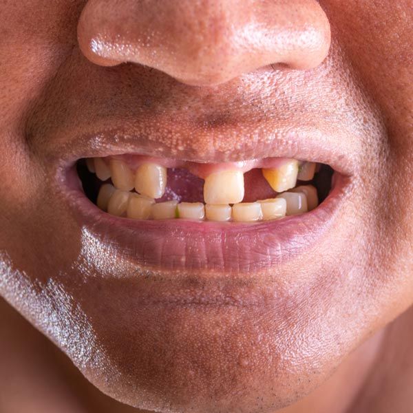Dentures St Louis Best Oral Surgeon Midwest Oral Surgery
