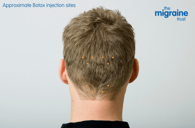 What Should You Not Do After Botox For Migraines Cosmetic Surgery Tips