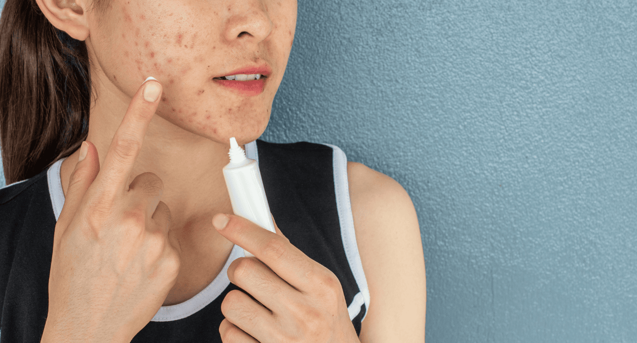 What to expect when using clindamycin gel for acne?