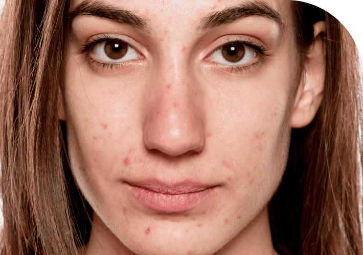 Online Acne Treatments Discover Solutions for Healthier Skin