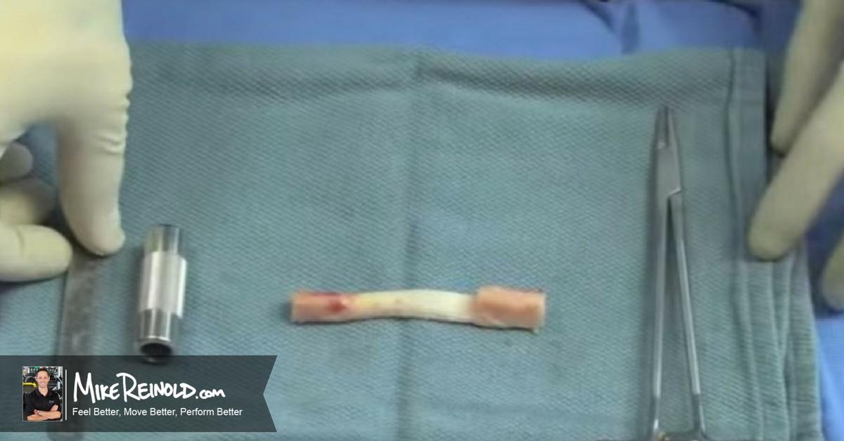 What is the Best Graft Choice for ACL Reconstruction? Mike Reinold