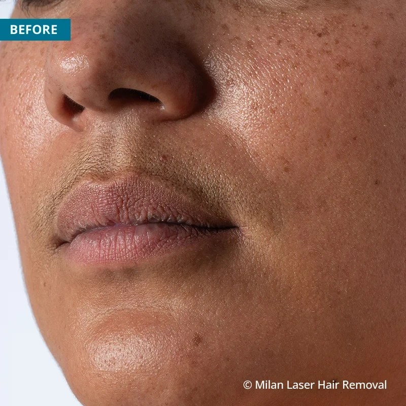 Face Before & After Photos of Laser Hair Removal Milan Laser