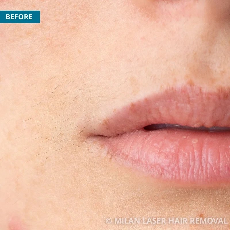 Face Before & After Photos of Laser Hair Removal Milan Laser