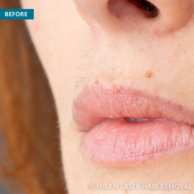 Face Before & After Photos of Laser Hair Removal Milan Laser