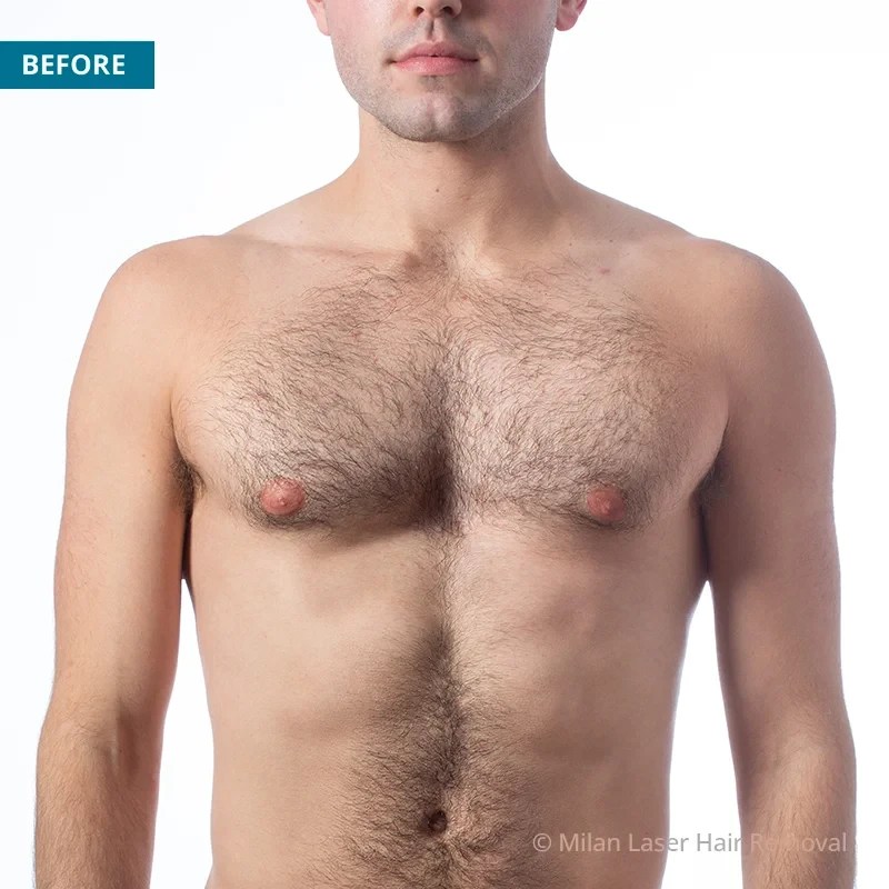 Men's Before & After Photos of Laser Hair Removal Milan Laser in