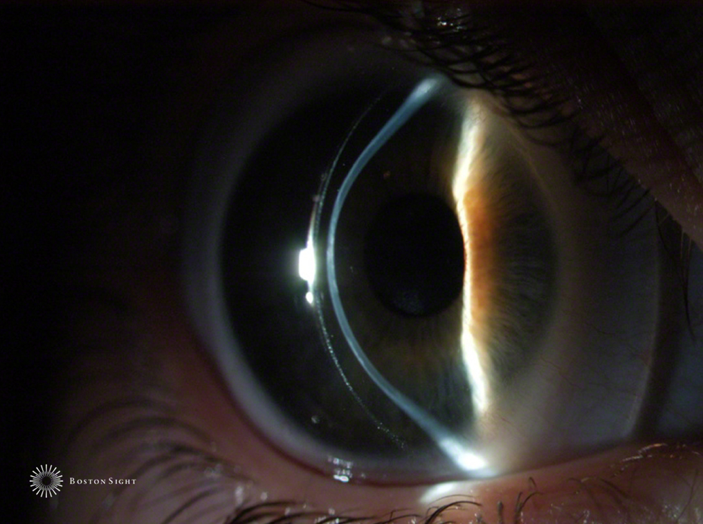MillennialEYE The PROSE Device for OSD and Corneal Ectasia