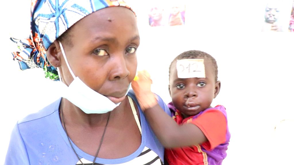 Extrême Nord les ravages du bec de lièvre Mimi Mefo Info