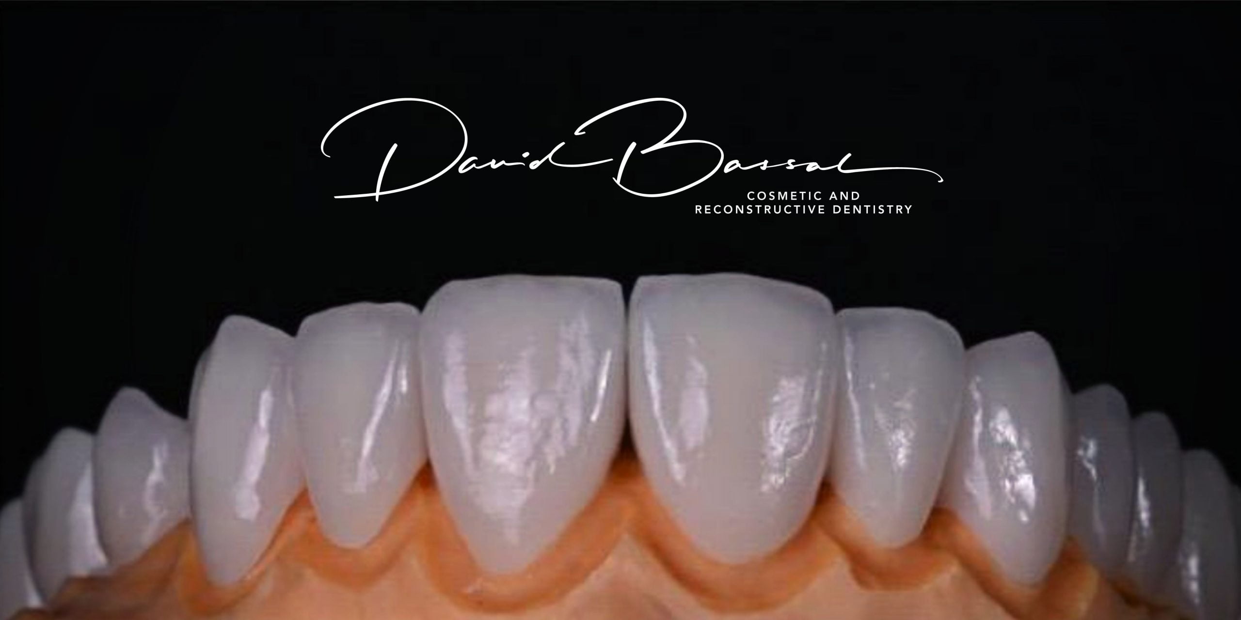 What are Veneers and How Much Do They Cost? Mingara Dental