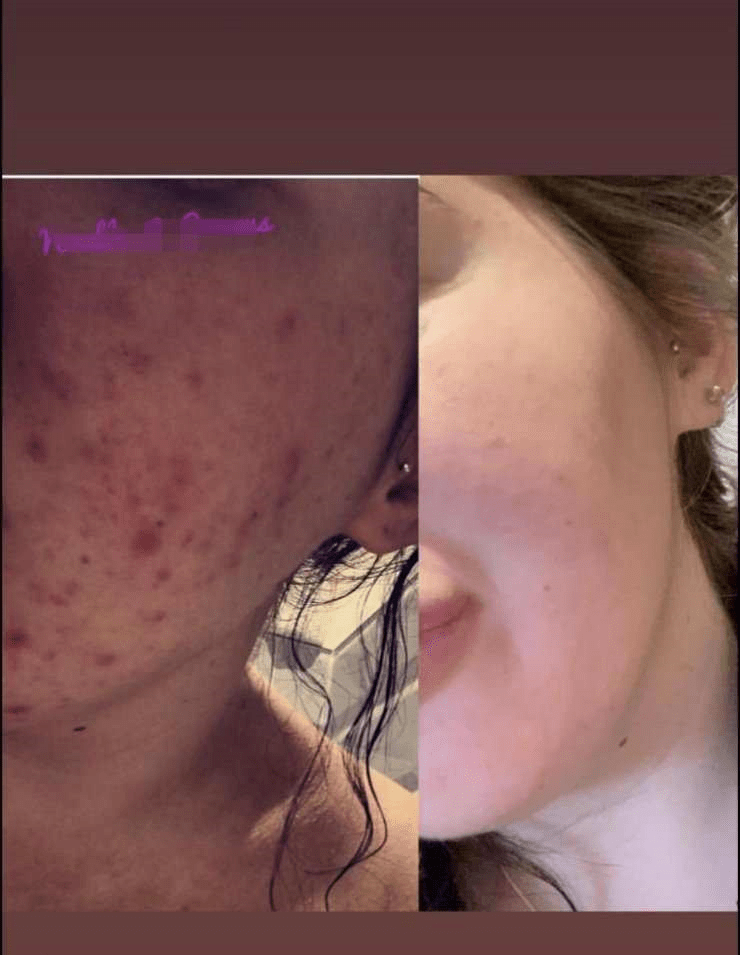 Organic Acne Lotion for Acne Prone Skin