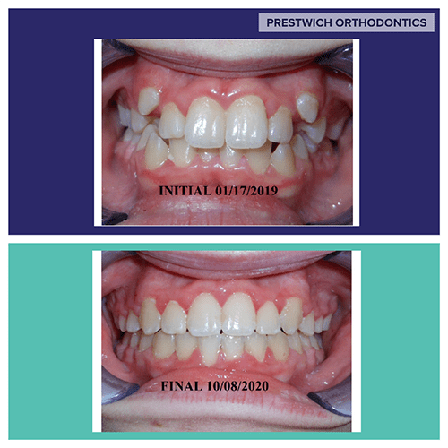 Before and After Orthodontist Minot ND Invisalign Braces Prestwich