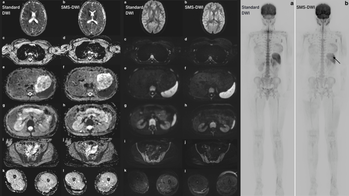 New Technique Speeds Up WholeBody MRI for Children Without Sacrificing