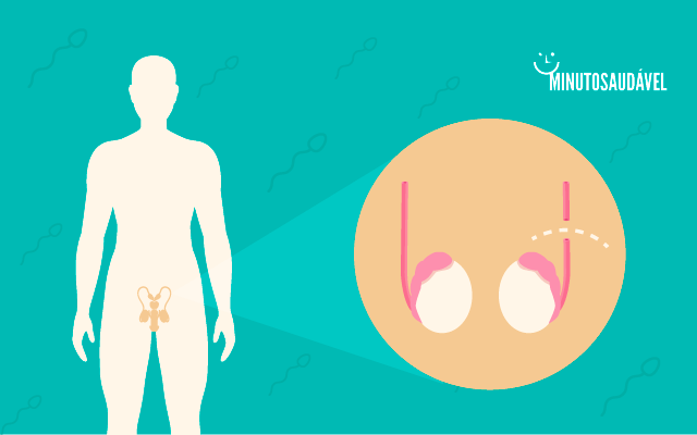 Vasectomia (cirurgia) tem reversão? Saiba se pode falhar MS