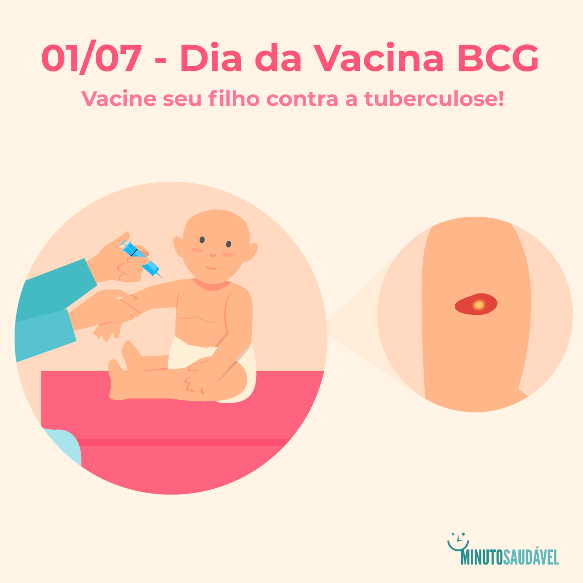 Vacina BCG dói? Veja quando tomar, a composição e o efeito MS
