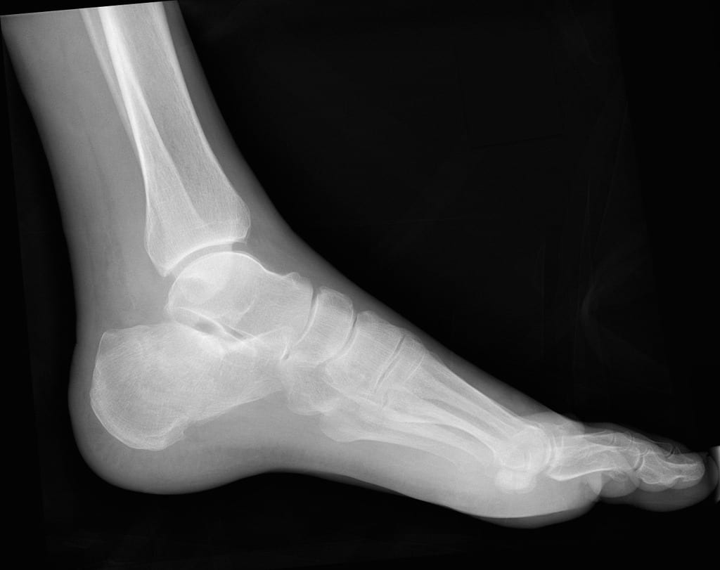 How do you treat a calcaneus fracture Miosuperhealth