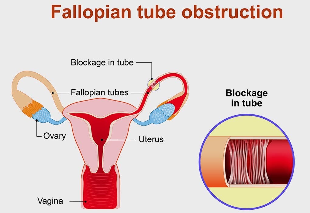 10 Tips To Unblock Fallopian Tubes Naturally With Herbs by Aasha