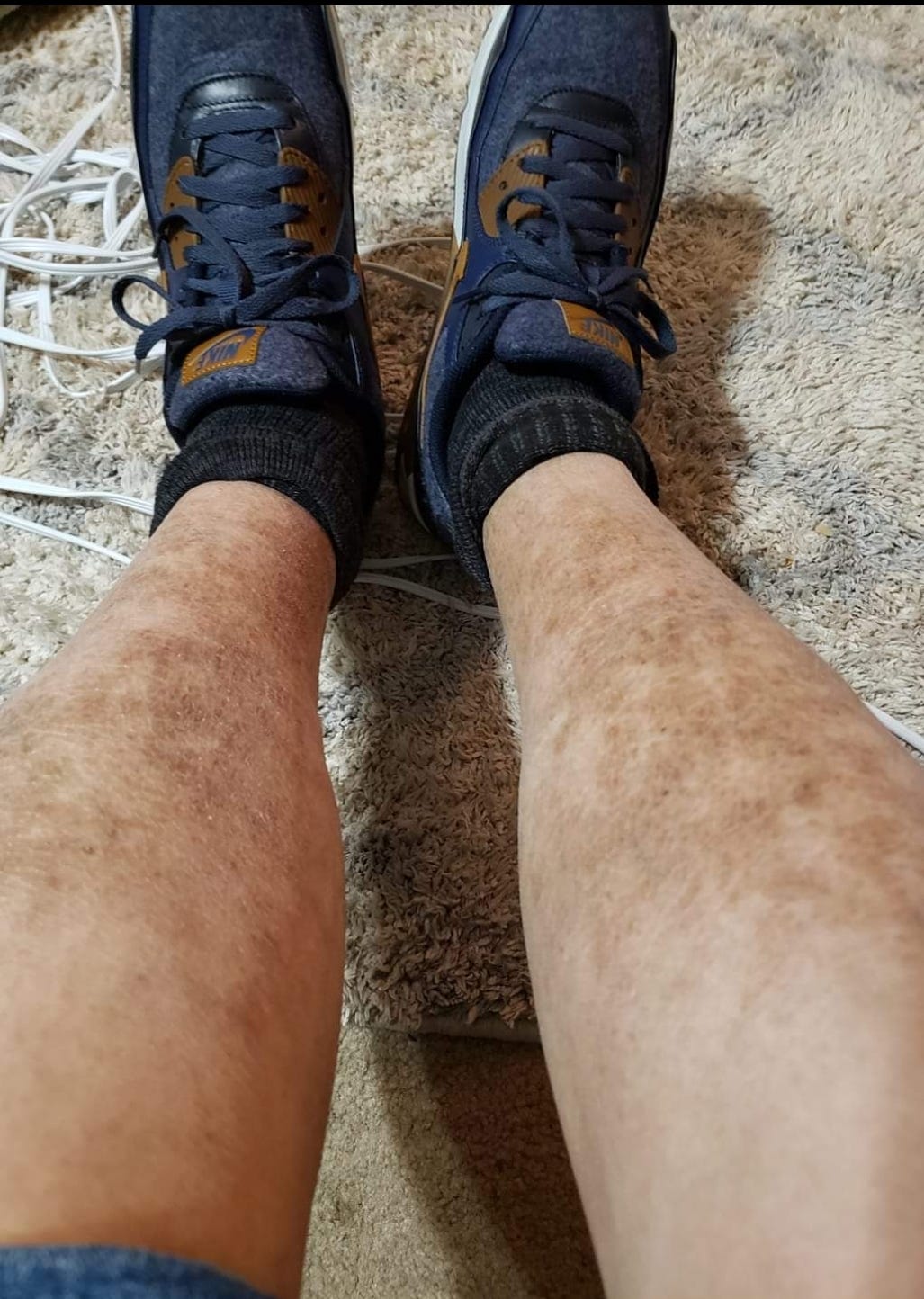 When you have cirrhosis of the liver, your liver has trouble processing