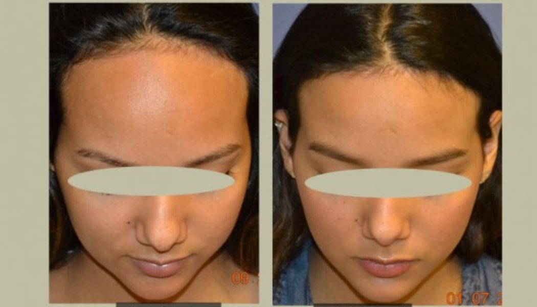 If You Have A High Hairline Why Not Consider Forehead Reduction Surgery