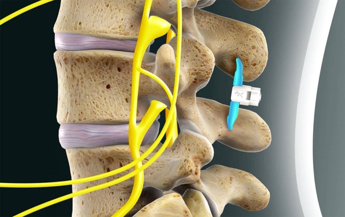 Vertiflex Interspinous spacer. Vertiflex interspinous spacer is a… by