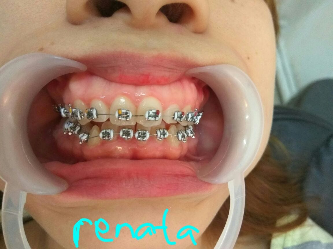 Behel metal , keramik, atau safir? by Tiny Elephant Medium