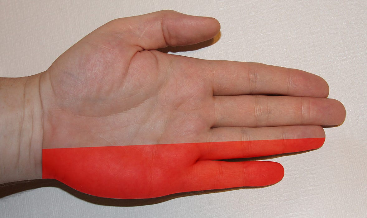 Not Carpal, it’s the Other Tunnel Syndrome by Chad Clabo Not Carpal, it’s the Other Tunnel Syndrome by Chad Clabo
